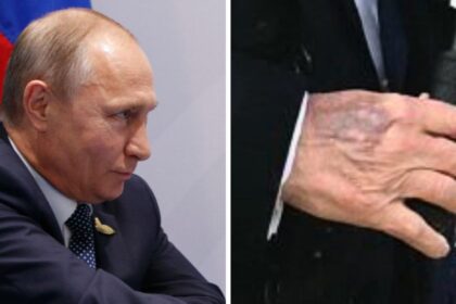 Vladimir Putin’s visibly swollen hand reignites global speculation over the Russian leader’s health