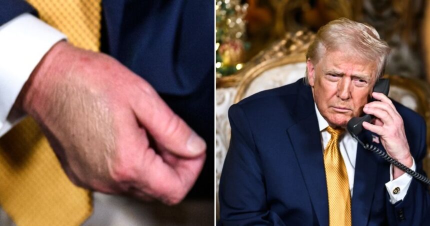 Donald Trump's new bruise on his left hand sparks concern