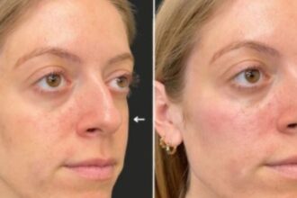 Ultrasound scans reveal how cosmetic fillers can accidentally block facial arteries, leading to serious medical complications