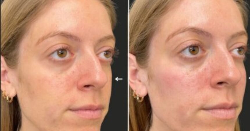 Ultrasound scans reveal how cosmetic fillers can accidentally block facial arteries, leading to serious medical complications