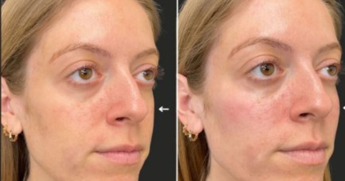 Ultrasound scans reveal how cosmetic fillers can accidentally block facial arteries, leading to serious medical complications