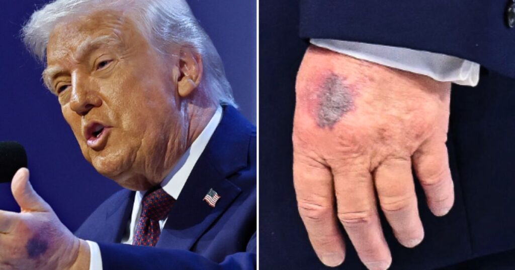 Donald Trump at Davos with a visible bruise on the back of his left hand