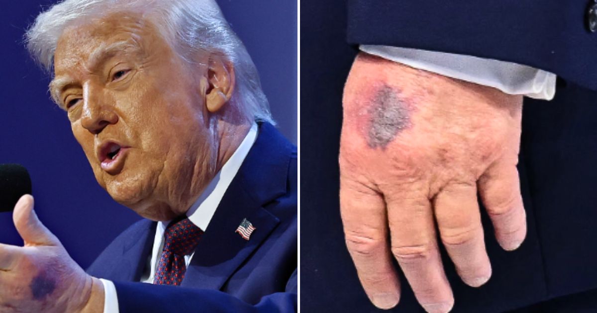 inquisitr.com - Sohini Sengupta - Trump's Bruised Hand Is Back - and His Latest Explanation Is Raising Eyebrows