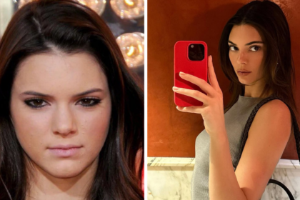 Before and after photos of Kendall Jenner.