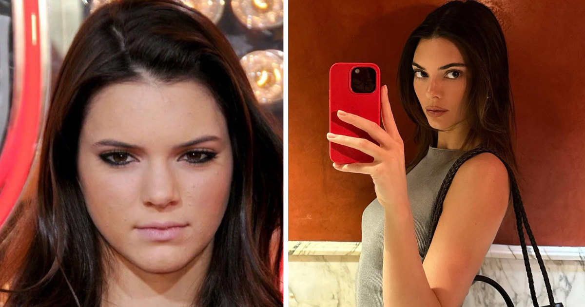 Before and after photos of Kendall Jenner.