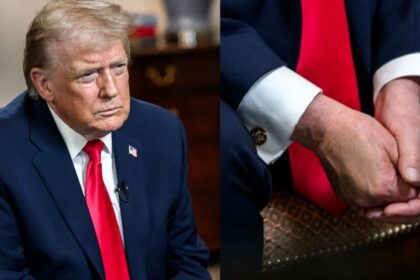 Trump’s bruised hands are back in spotlight