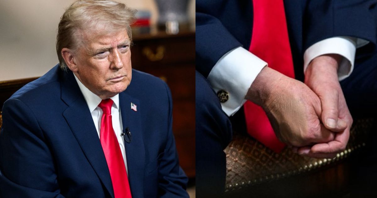 Trump’s bruised hands are back in spotlight
