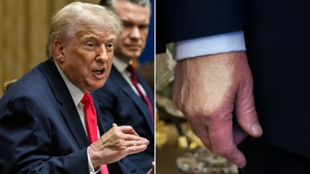 Eagle-eyed Internet sleuths spot two fresh bruises on Trump's hand after 24 hours, sparking rumors.