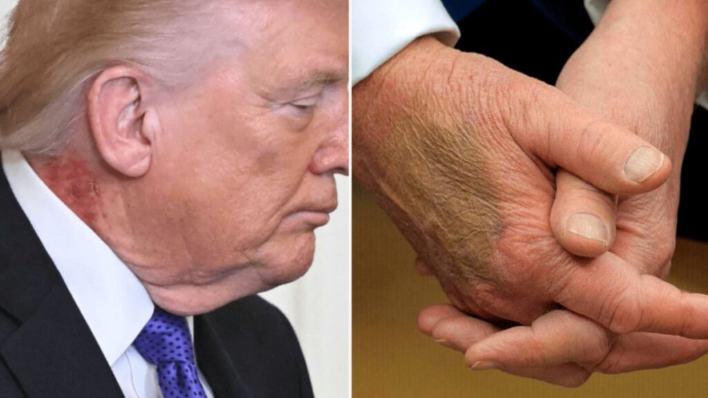 Donald Trump's neck rash renews health concerns.