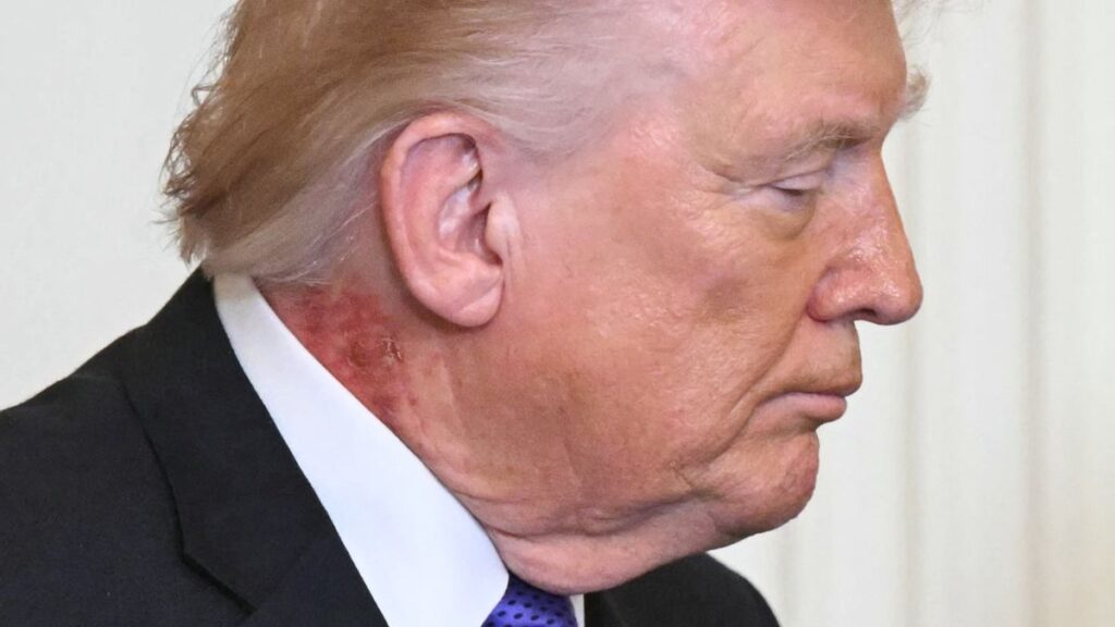 Donald Trump gets new neck rash