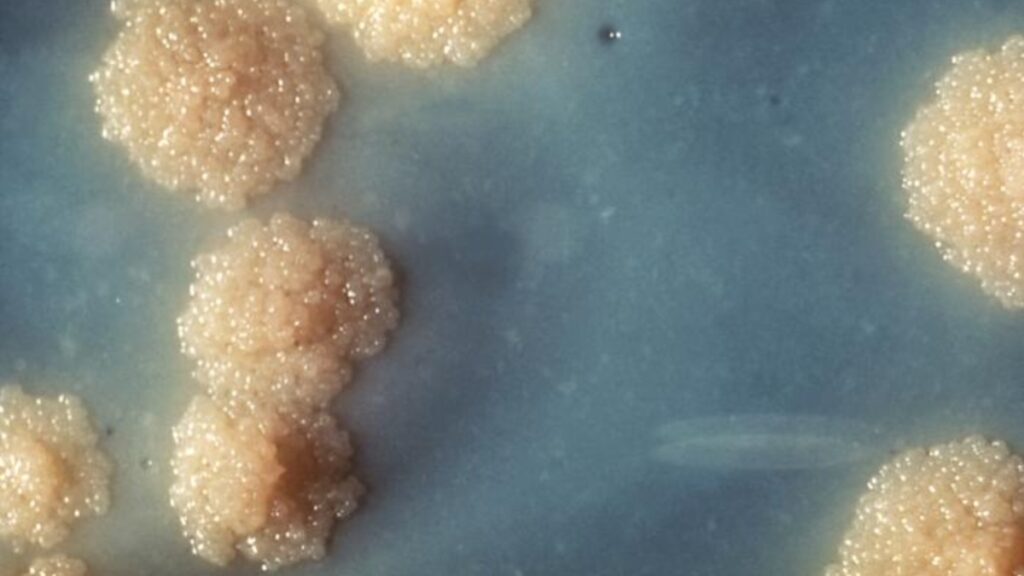 Tuberculosis is rising in the United States, warn experts