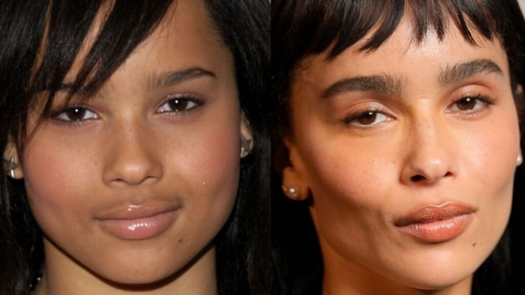Zoe Kravitz and many other celebs have come under the radar for undergoing Buccal fat removal surgery