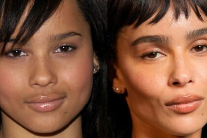 Zoe Kravitz and many other celebs have come under the radar for undergoing Buccal fat removal surgery