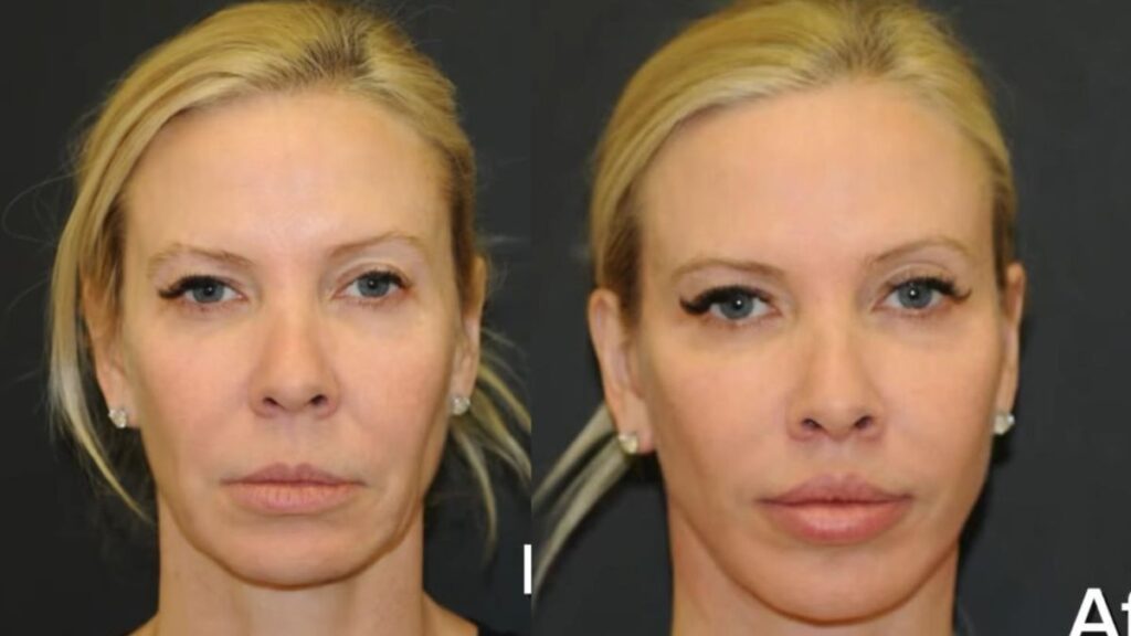 Kerry Berlet trusted her plastic surgeon husband to perform a facelift surgery on her. (Image Credit: @kerry111111/ Instagram)