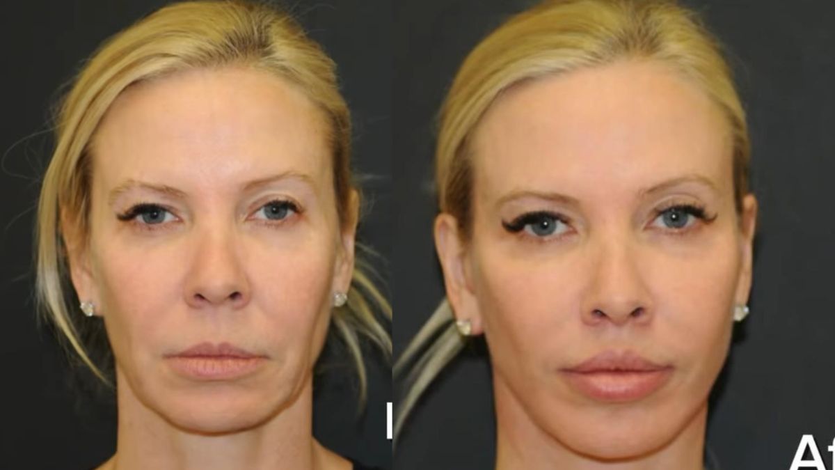 Woman, 51, Receives Facelift From Plastic Surgeon Husband — Reveals Hardest Part of Recovery