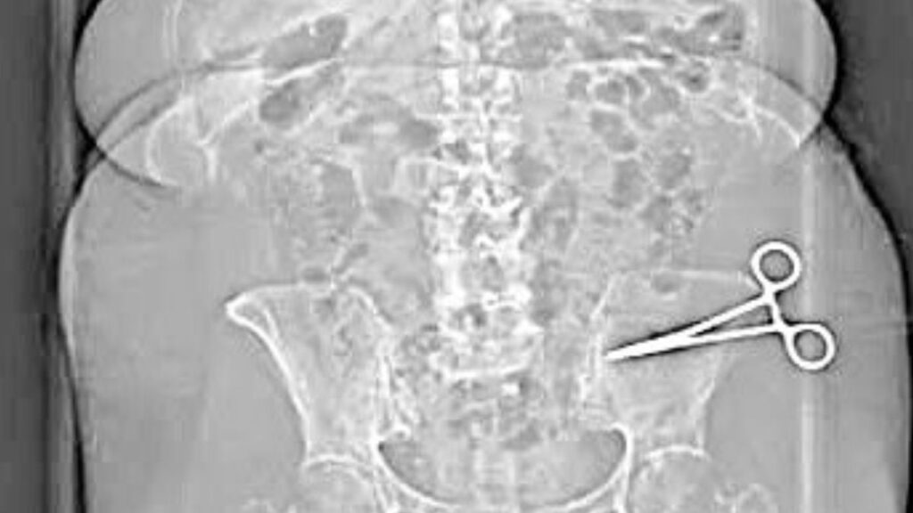 A woman in Italy filed a police complaint after surgeon forgot scissors in her stomach