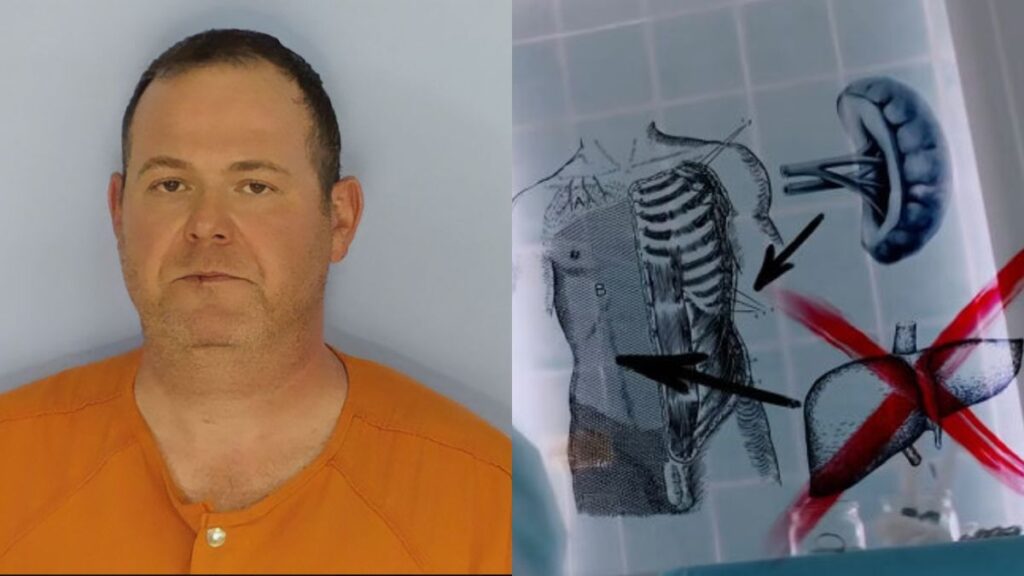 Florida surgeon removes liver instead of spleen, killing a patient.