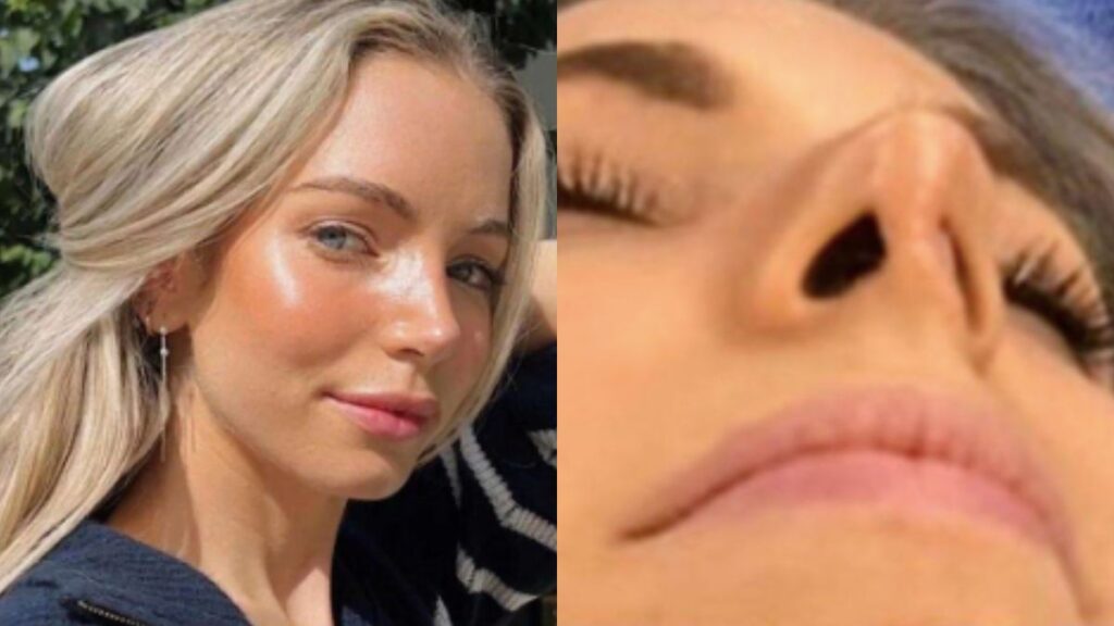 Free nose job ended up costing this woman way more